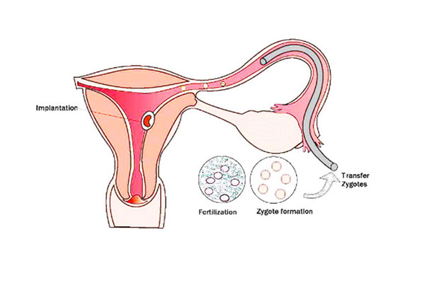 The procedure of GIFT involves the transfer of female gamete to the  fallopian tube Can gametes be transferred to the uterus to achieve the  same result Explain